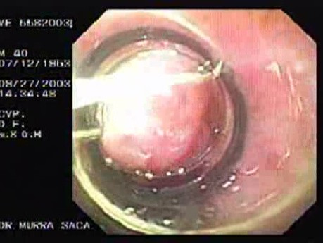 Acute Variceal Bleeding - Follow Up and Further Ligation of Varices