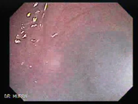 Endoscopic view of Rectal Stalked Polyp (4 of 7)