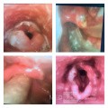 Acute Epiglottitis with Epiglottic Abscess