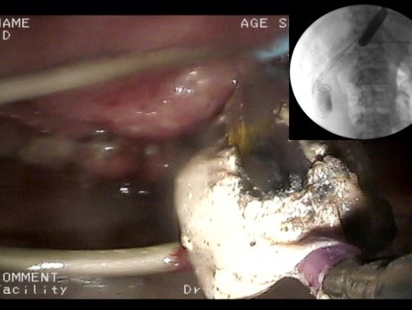 Endoscopic Treatment of Consequences of Acute Necortizing Pancreatitis