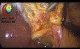 Is it Justified to Dissect the Cystic Duct to Such Extent to Avoid Leaving a Somewhat Long Cystic Duct with a Possible Small Gravel Within