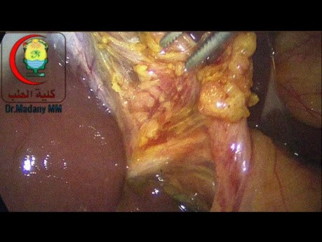 Is it Justified to Dissect the Cystic Duct to Such Extent to Avoid Leaving a Somewhat Long Cystic Duct with a Possible Small Gravel Within