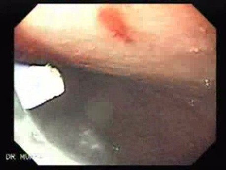 Multiple Gastric Angiodysplasia (12 of 17)