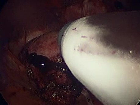 Closed Contained Power Tissue Extraction