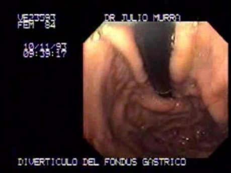 Gastric Fundus Diverticulum
