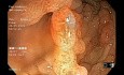 Familial Adenomatous Polyposis