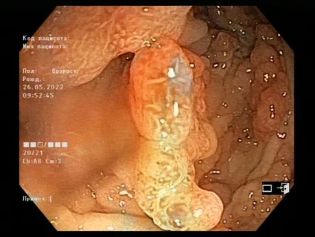 Familial Adenomatous Polyposis