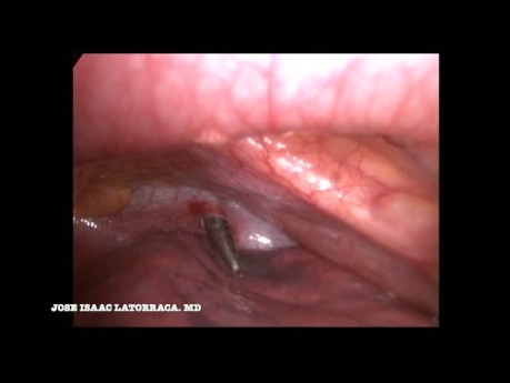Removal of a Stab in the Neck by Video-assisted Thoracoscopy. Trauma Unit & Cardiovascular Surgery.