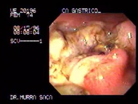 Adenocarcinoma of the Corpus