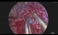 VATS Segmentectomy: Abnormal A1+A3 Trunk During Apicoposterior Segmentectomy