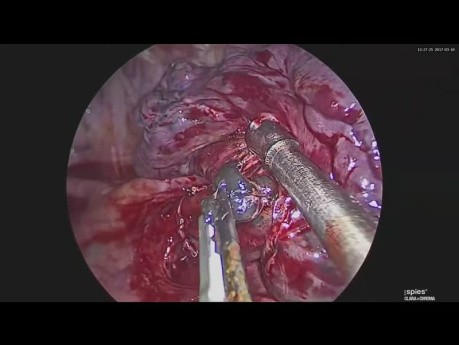 VATS Segmentectomy: Abnormal A1+A3 Trunk During Apicoposterior Segmentectomy
