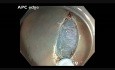 Colonoscopy - Ascending Colon Flat Lesion EMR
