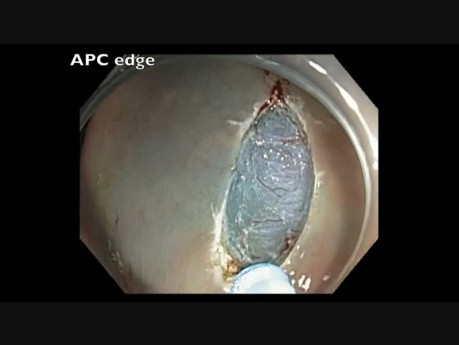 Colonoscopy - Ascending Colon Flat Lesion EMR