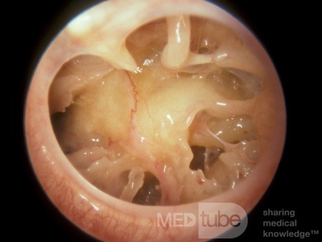 Large Traumatic Perforation Tympanic Membrane [hot soup]