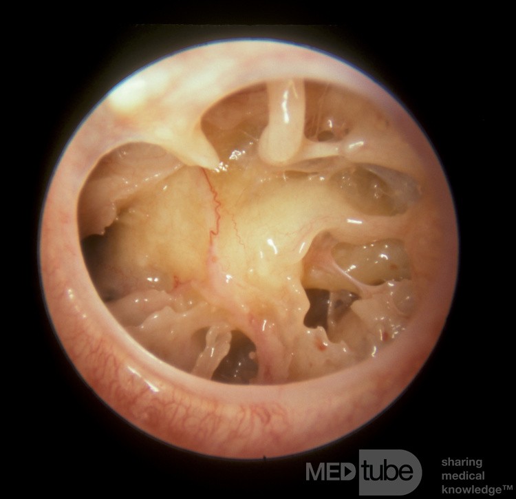 Large Traumatic Perforation Tympanic Membrane [hot soup]