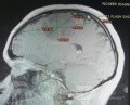 Surgical Planning with Neuronavigator in Patient with Intracranial Mass Lesion. High Grade Glioma.