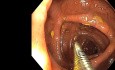 Endoscopic Giant Polyp Polypectomy - Transverse Colon