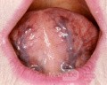 Normal Tongue [sublingual blood vessels]