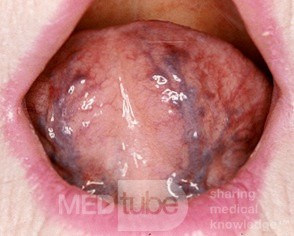Normal Tongue [sublingual blood vessels]
