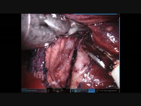 Robotic Sixth Lung Segmentectomy