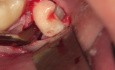 Germectomy of inferior wisdom tooth with an alternative instrument. 