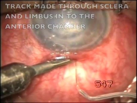 Microtrack filtration to the anterior chamber
