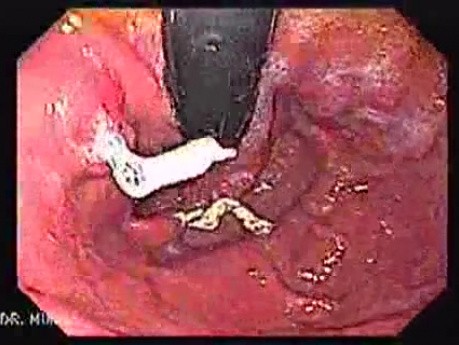 Longstanding gastroesophageal reflux disease (1 of 7)