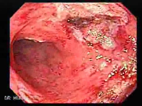 Post-Radiation Colitis (9 of 13)