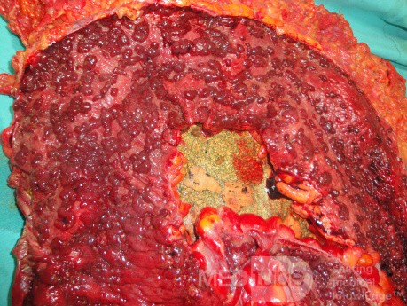 Multiple Rectal Ulcers (89 of 110)