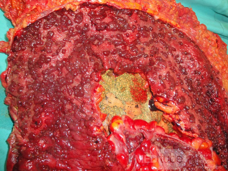 Multiple Rectal Ulcers (89 of 110)