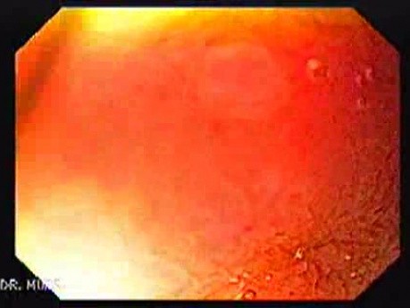 Brunner's Gland Hyperplasia (2 of 3)
