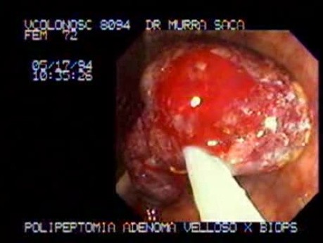 Video Colonoscopic view of a polypectomy of a big 6 cm. x 4 cm. sessile lesion (2 of 4)