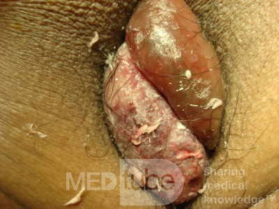 Acute Trombosed hemorrhoids 2