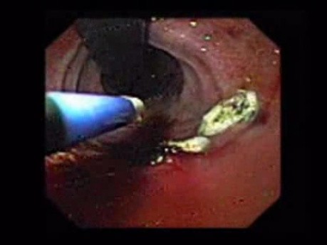 Mallory-Weiss Syndrome - Hemostatic Therapy with Argon Plasma Coagulator, Part 2