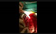 Multiorgan / Compartmental Resection for Reccurent Retro-Peritoneal Tumor