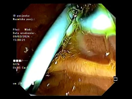 Disrupted Biliary Tree Treatment