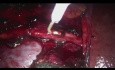 Retroperitoneal Right Lymph Node Dissection