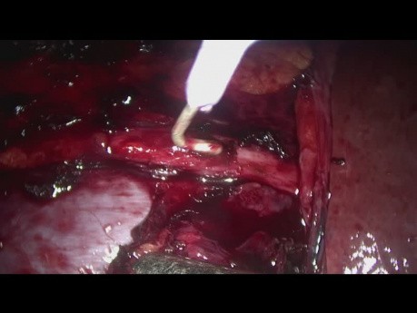 Retroperitoneal Right Lymph Node Dissection