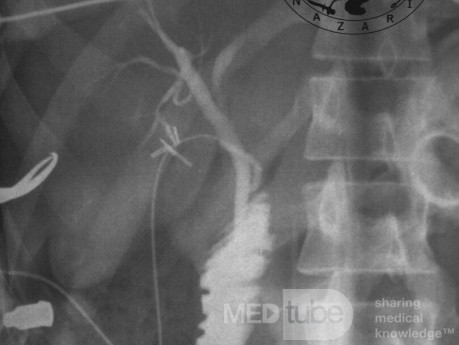 Low Junction of the Cystic Duct #1