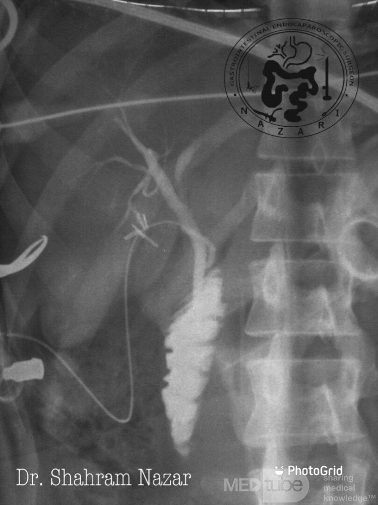 Low Junction of the Cystic Duct #1