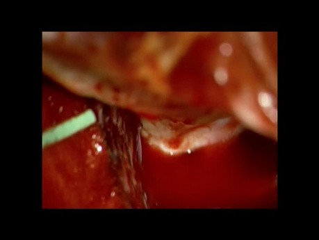 Aneuryma PCom