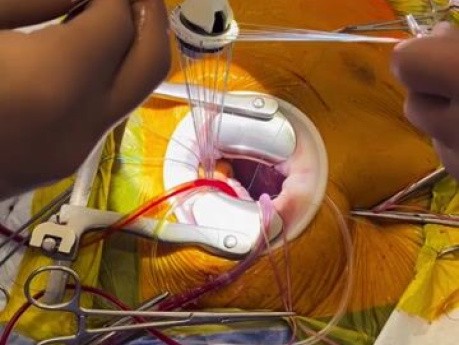 Aortic Valve Replacement via RAT