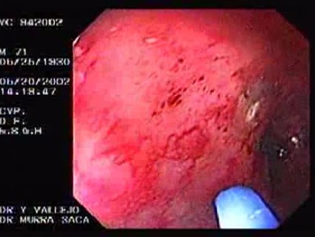 Radiation Proctosigmoiditis (4 of 14)