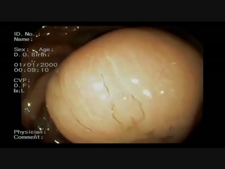 Gastric Tumor