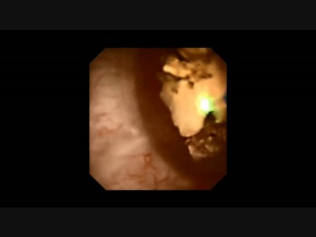 RIRS, Upper and Lower Left Calyceal Stones