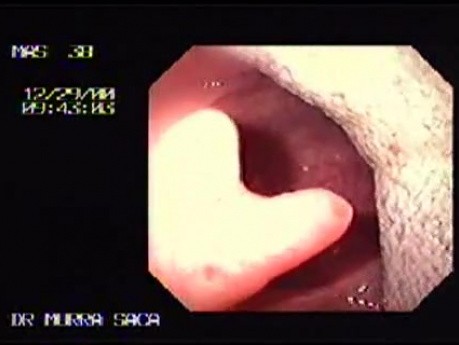 Bilobulated Uvula