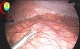 Complicated Appendix