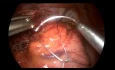 Redo Nissen with Slowly Resorbable Hiatal Mesh Placement