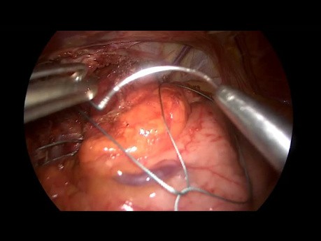 Redo Nissen with Slowly Resorbable Hiatal Mesh Placement