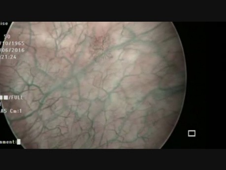 Narrow Band Illumination - Bladder Mass